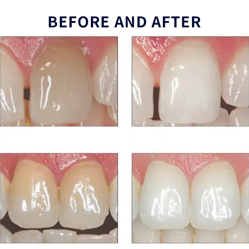 Opalescence Whitening 20% PF 2 – Teeth Whitening From Home recenzja i cena