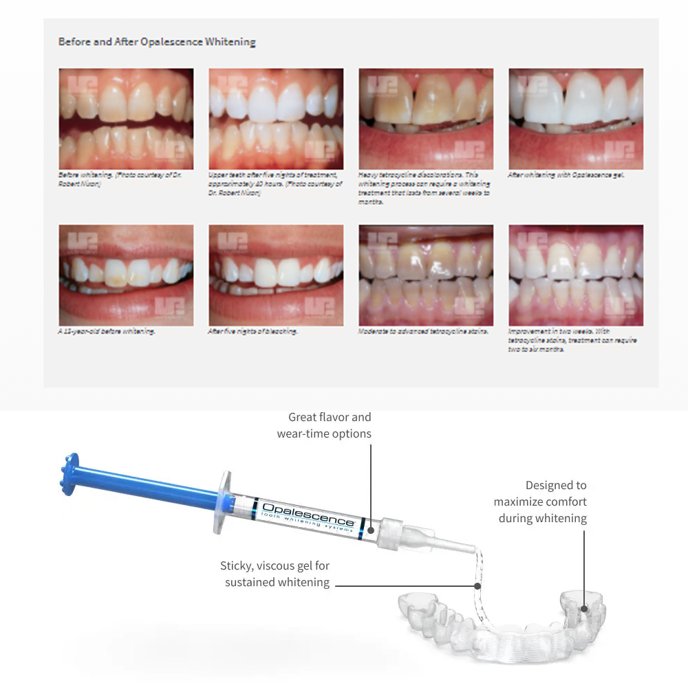 Opalescence Whitening 20% PF 2 – Teeth Whitening From Home recenzja i cena