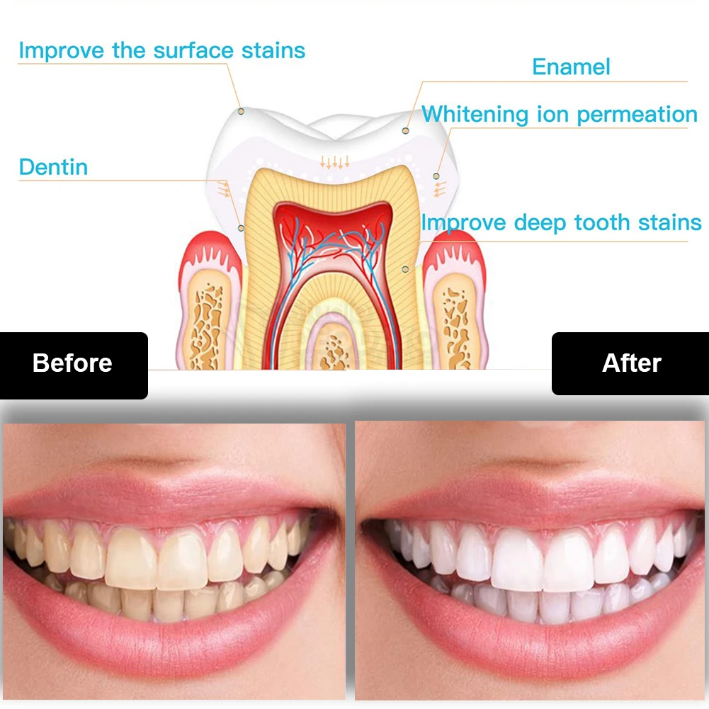 Zestaw do wybielania zębów den – Teeth Whitening From Home recenzja i cena